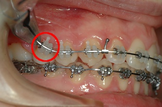 Cas d'urgence au Cabinet d'orthodontie exclusive du Dr. FAVALI à Dax